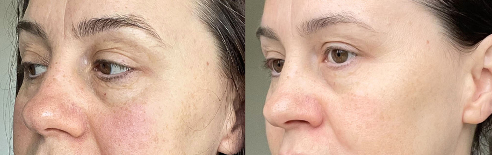 RF skin tightening device before and after wrinkles look smoother on client